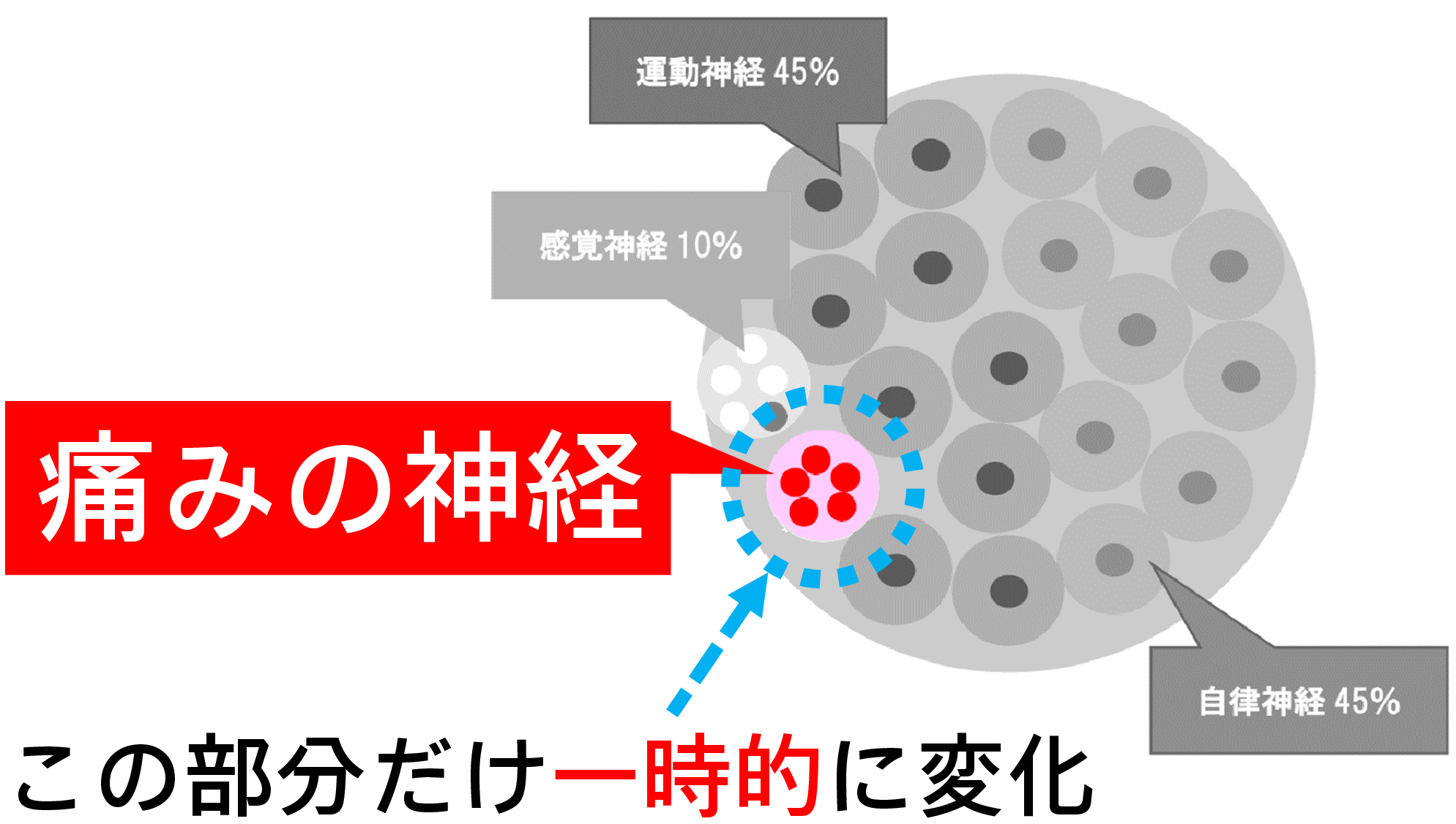 坐骨神経痛