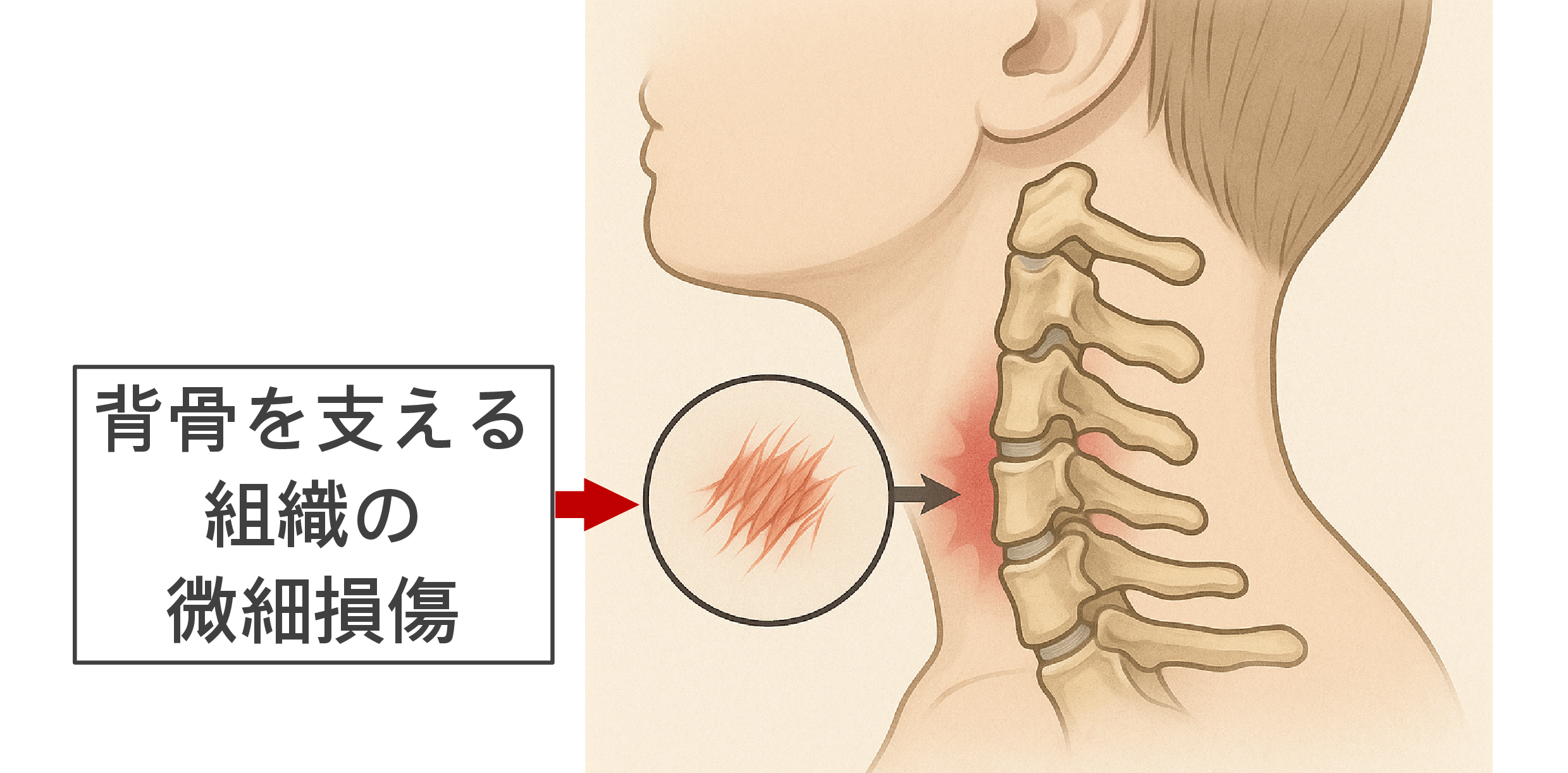 頸椎椎間板ヘルニア